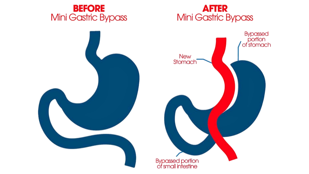 Gastric Bypass Surgery